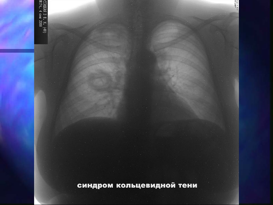 Рентгенологические синдромы легких. Синдром кольцевидной тени на рентгенограмме. Синдром кольцевидной тени на рентгенограмме легких. Кольцевидные тени в легких на рентгене. Кольцевидная тень на рентгенограмме легких.