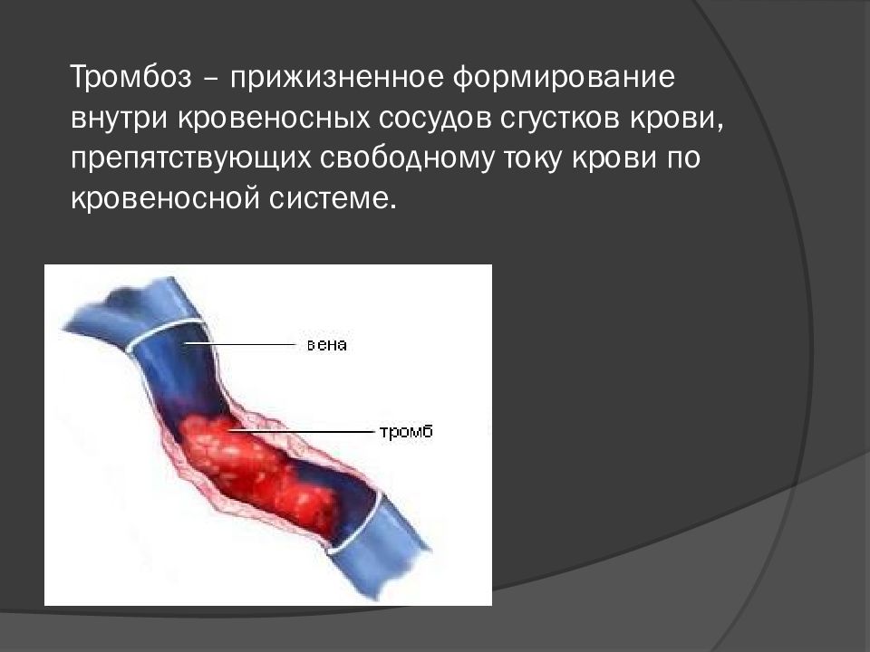 Тромб это. Илеофеморальный венозный тромбоз. Илеофеморальный тромбоз гангрена. Илеофеморальный венозный тромб. Илеофеморальный венозный тромбоз хирургия.