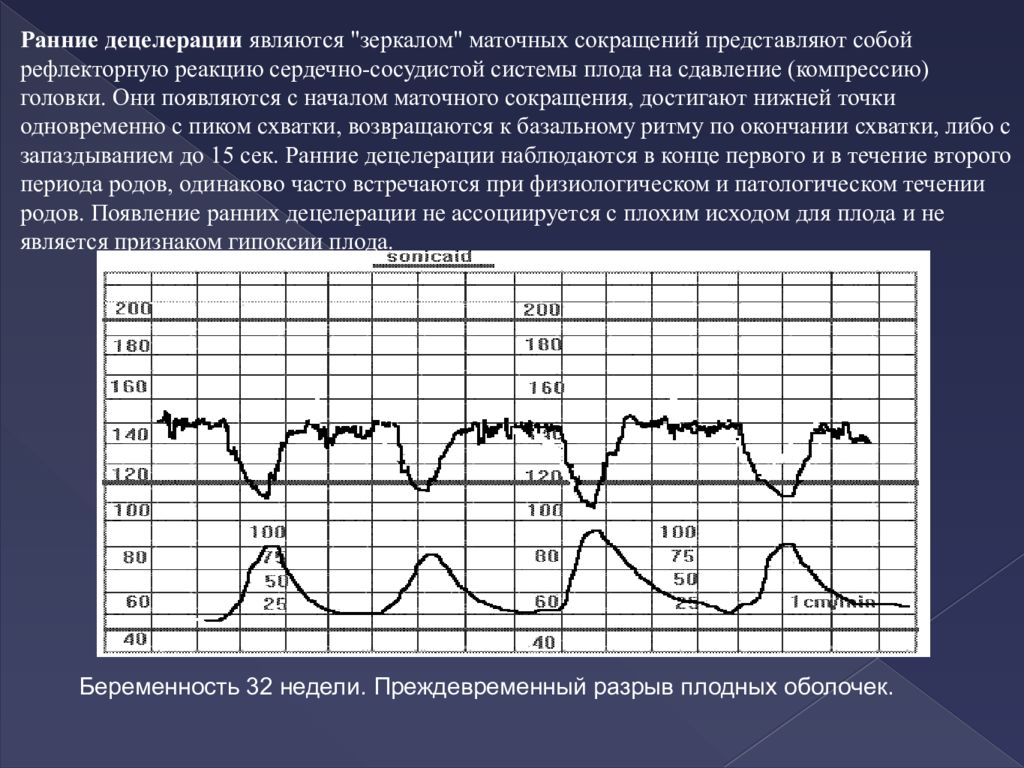 Гипоксия плода при беременности. Гипоксия КТГ показатели. Нормальный Тип Кривой КТГ. КТГ У плода при гипоксии показатели. Базальный ритм на КТГ.