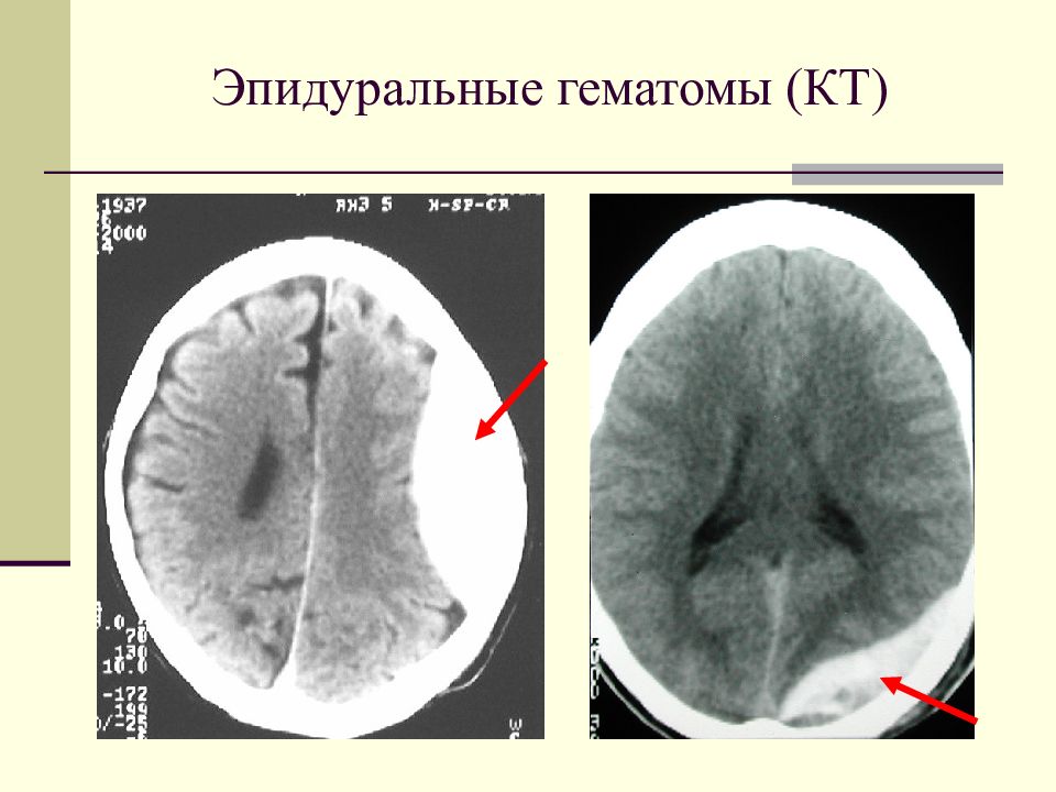 Эпидуральная гематома на кт