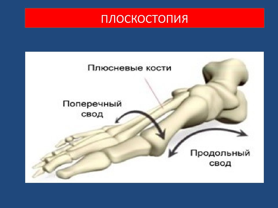 Деформации стоп презентация