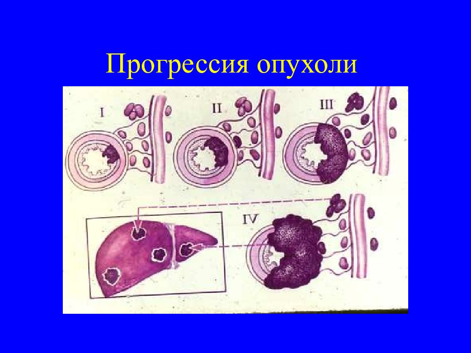 Опухолевая прогрессия презентация