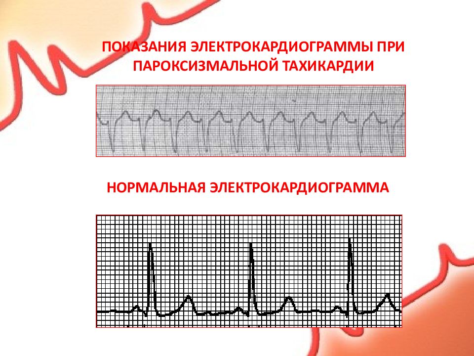 Пароксизмальная тахикардия на экг. ЭКГ при пароксизмальной тахикардии. Ритм при пароксизмальной тахикардии. Наджелудочковая тахикардия на ЭКГ. Показания тахикардия.