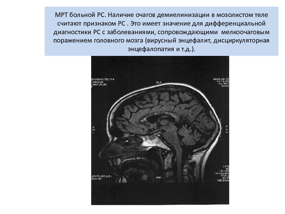 Мр картина демиелинизирующего заболевания головного мозга