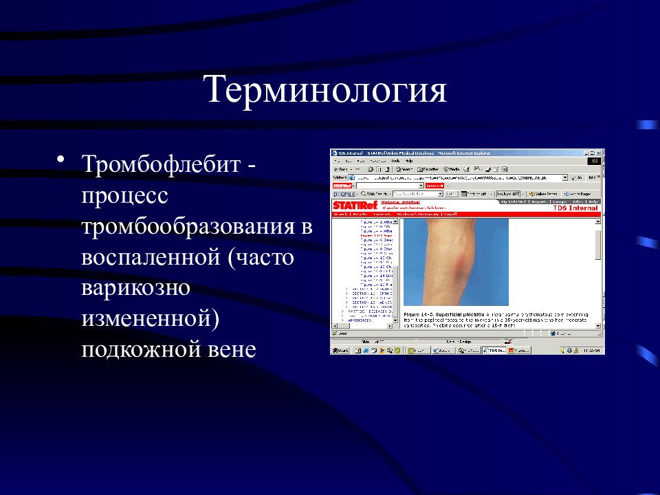 Тромбофлебит код. Тромбофлебит классификация. Тромбофлебит презентация. Флеботромбоз презентация хирургия. Посттромбофлебитический синдром нижних конечностей.