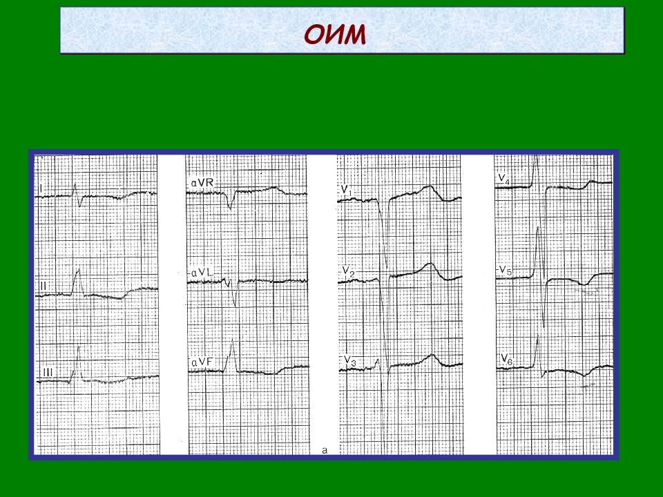 Оим. Заднебазальный инфаркт ЭКГ. ЭКГ при остром инфаркте миокарда. ЭКГ при заднебазальном им.