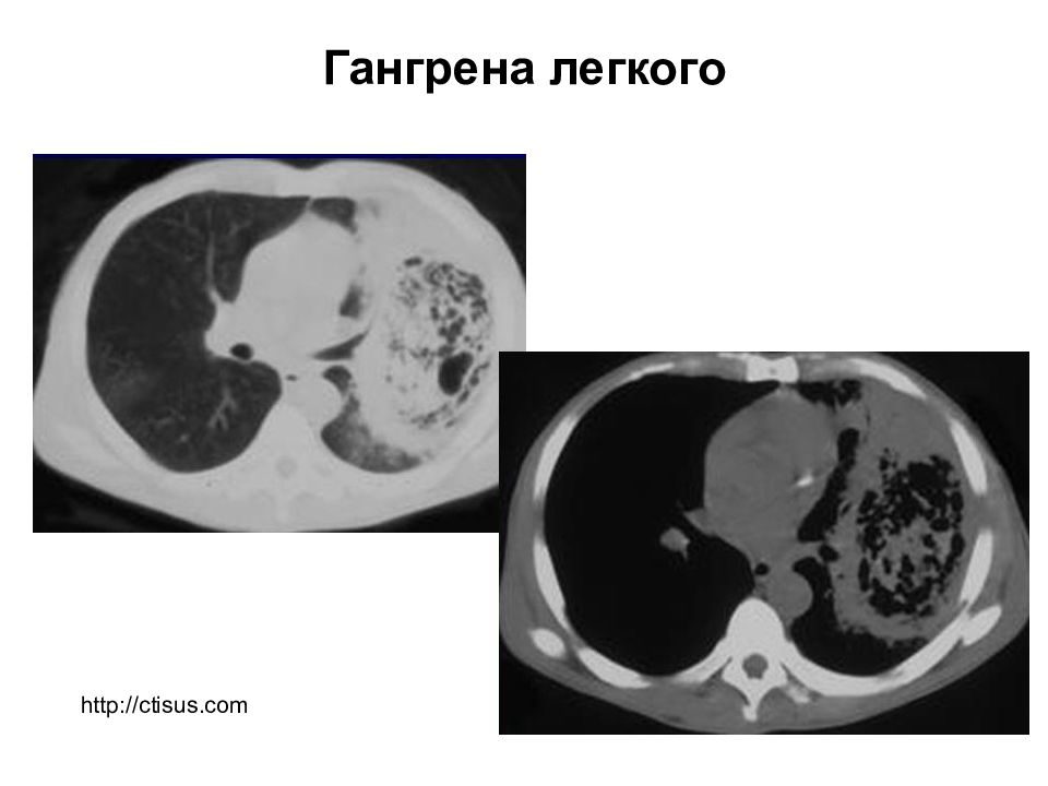 Гангрена легкого презентация