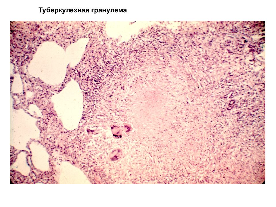 Стенка хронической туберкулезной каверны микропрепарат