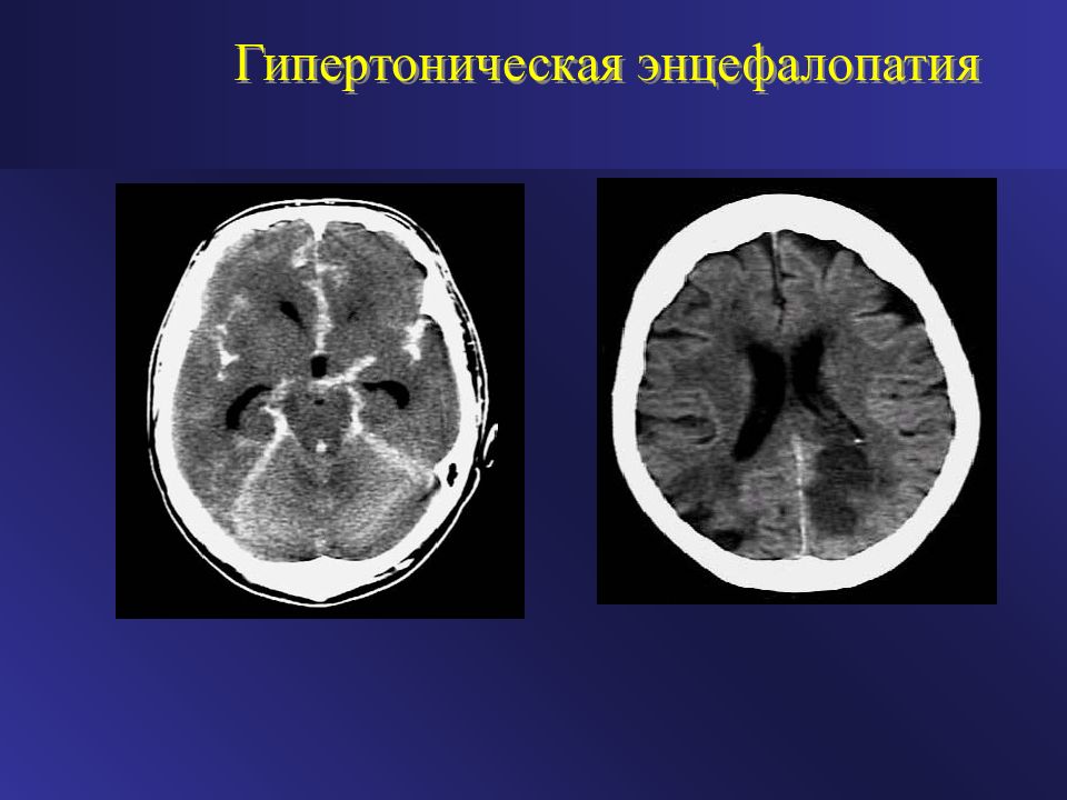 Почечная энцефалопатия презентация