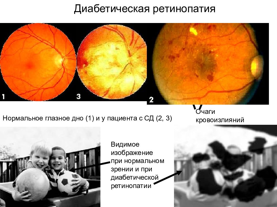 Диабетическая ретинопатия