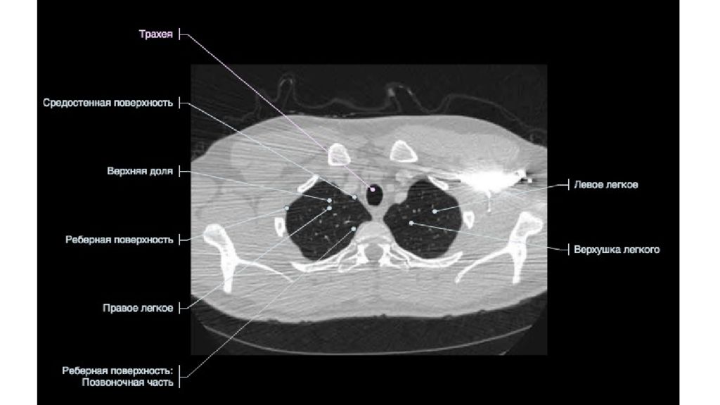 Где проходит кт. Выпот грудной клетки на кт. Кт органов грудной клетки с обозначениями. Кт анатомия грудной клетки. Кт анатомия органов грудной клетки.