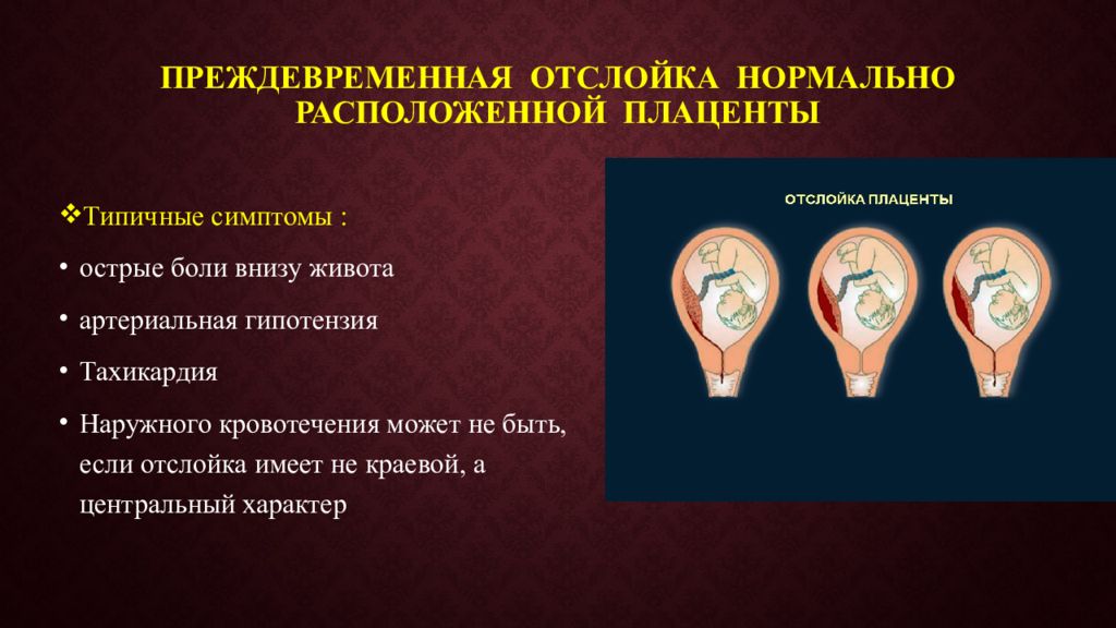 Отслойка плаценты. Преждевременная отслойка плаценты проявления. Отслойка нормально расположенной плаценты симптомы. Преждевременная отслойка нормально расположенной плаценты. Преждевременная отслойка нормально расположенной плаценты симптомы.