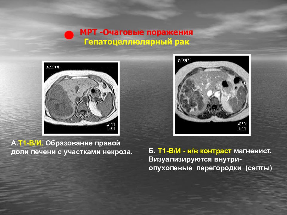 Очаговое поражение печени. Очаговые поражения печени презентация. Очаговые образования печени мрт. Гепатоцеллюлярное повреждение.