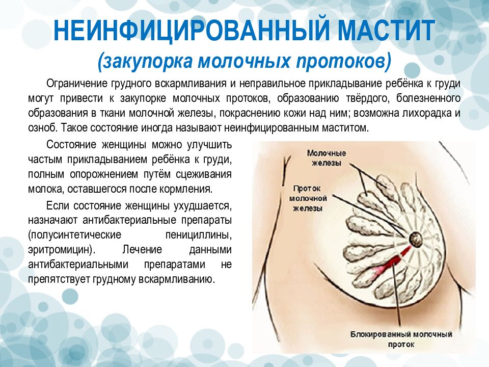 Симптомы мастита. Мастит при грудном вскармливании 1. Закупорка молочного протока. Закупорка молочного протока гв. Закупорка протока молочной железы.