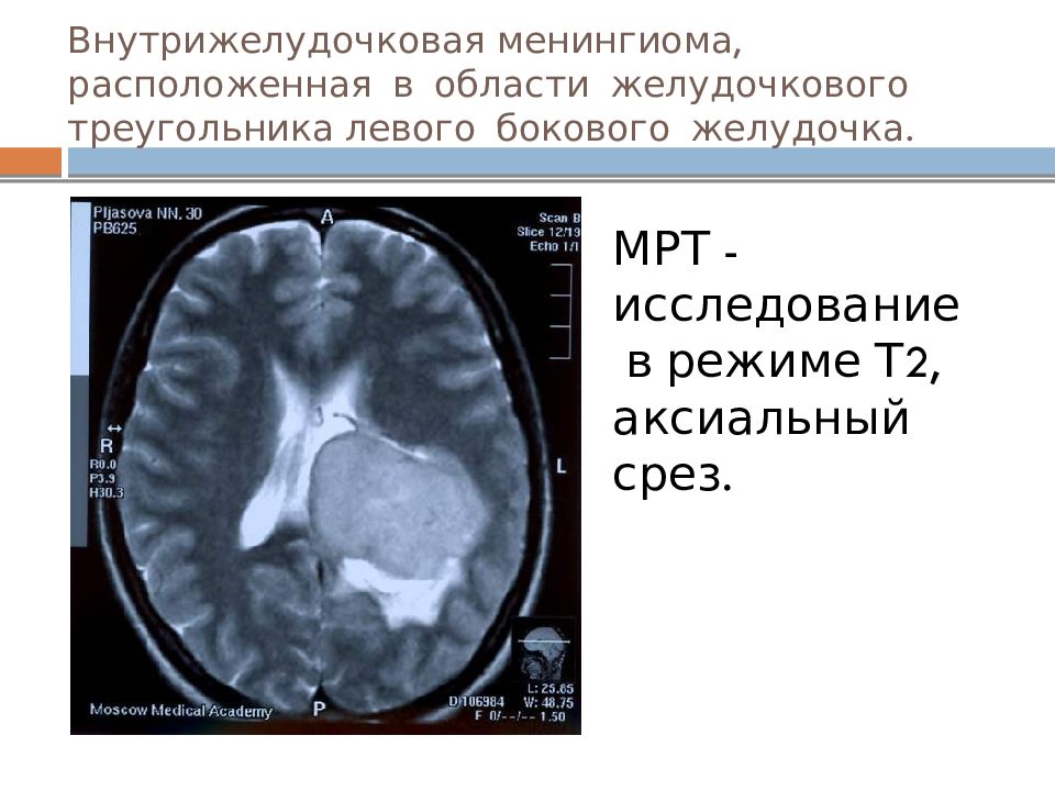 Опухоль головного мозга презентация