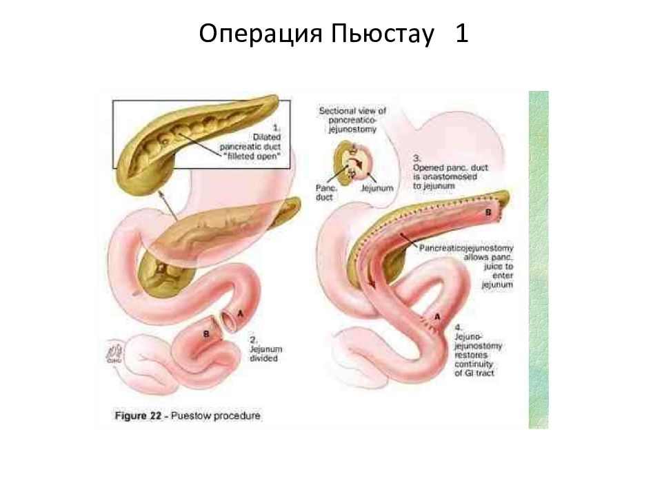 Заболевания поджелудочной железы хирургия презентация