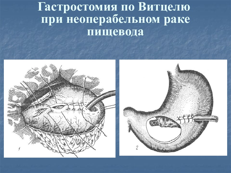Наложение гастростомы при неоперабельном раке пищевода. Чрескожная гастростома эндоскопическая. Наложение гастростомы. Этапы наложения гастростомы по витцелю. Наложение гастростомы при неоперабельном раке пищевода.