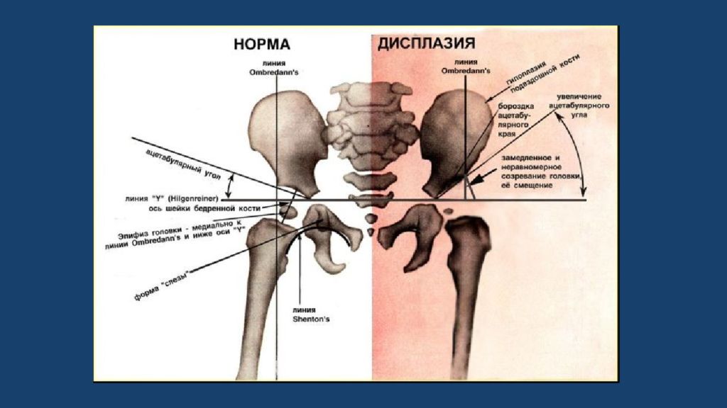 Сайт тбс. Дисплазия ТБС схема. Дисплазия тазобедренных суставов рентген. Дисплазия углы норма. Дисплазия тазобедренных суставов рентген схемы.