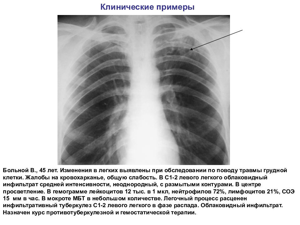 Инфильтративный туберкулез легких презентация