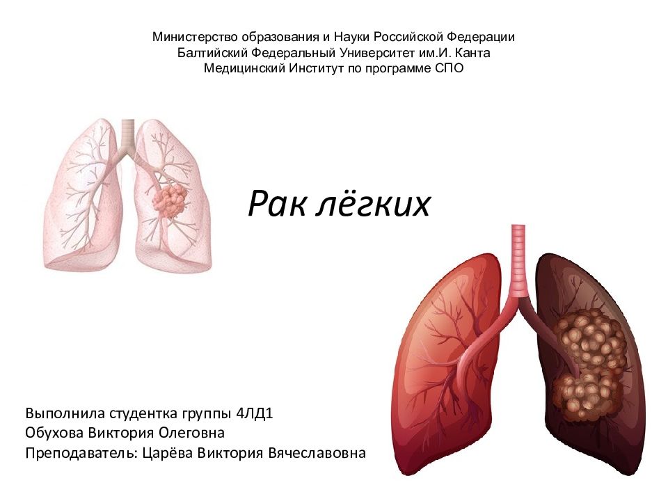 Передается ли рак. Раковые заболевания легких. Легкие для презентации. Онкологические заболевания легких презентация. Онкозаболевание легких.