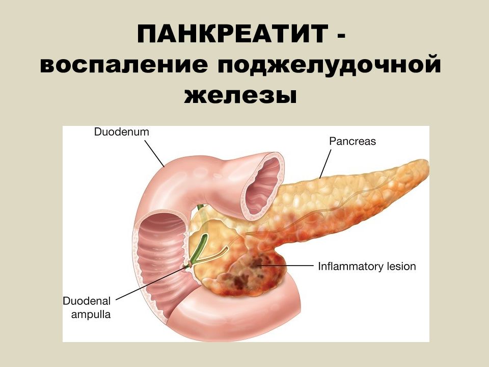 Панкреатит железа