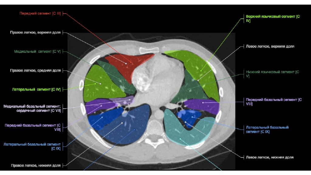 Доли легкого на кт. Сегменты легких кт Radiology 24. Сегменты легких кт Труфанов. Язычковые сегменты легких кт. Сегменты легких кт Хофер.