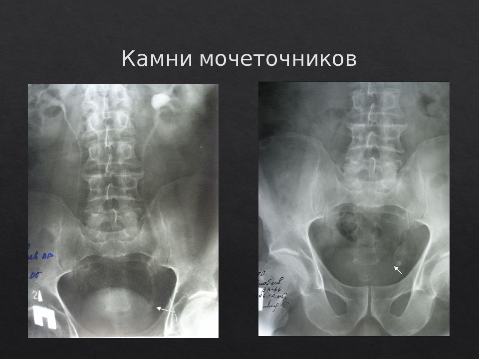 Беременность и мочекаменная болезнь презентация