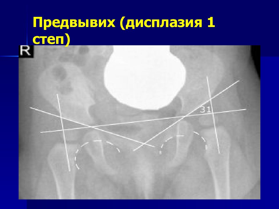 Дисплазия 1 степени форум. Предвывих или дисплазия.