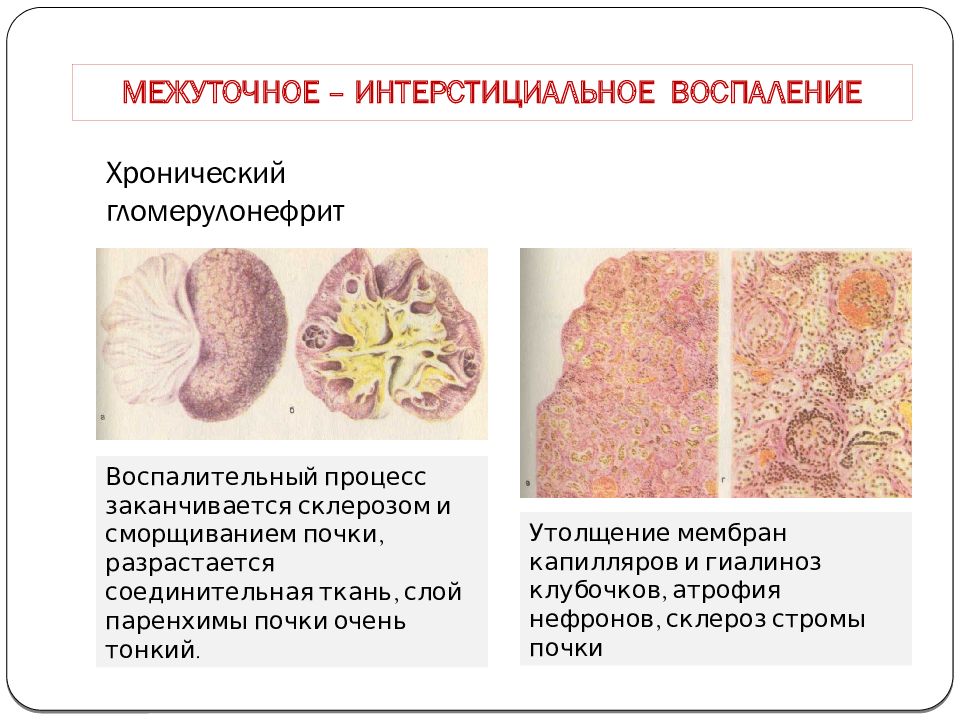 Воспаление. Межуточное воспаление. Интерстициальное воспаление. Межуточное продуктивное воспаление. Хроническое диффузное интерстициальное воспаление.