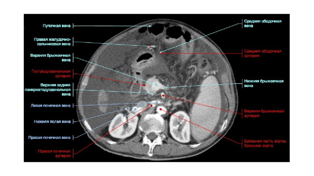 Кт обл. Группы лимфатических узлов брюшной полости кт. Лимфоузлы брюшной полости на кт анатомия. Мрт брюшной полости аксиальный срез. Лимфатические узлы брюшной полости кт анатомия.