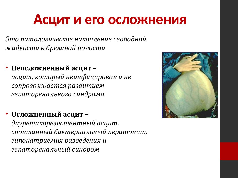 Асцит перитонит. Цирроз печени голова медузы асцит. Асцит локальный статус.