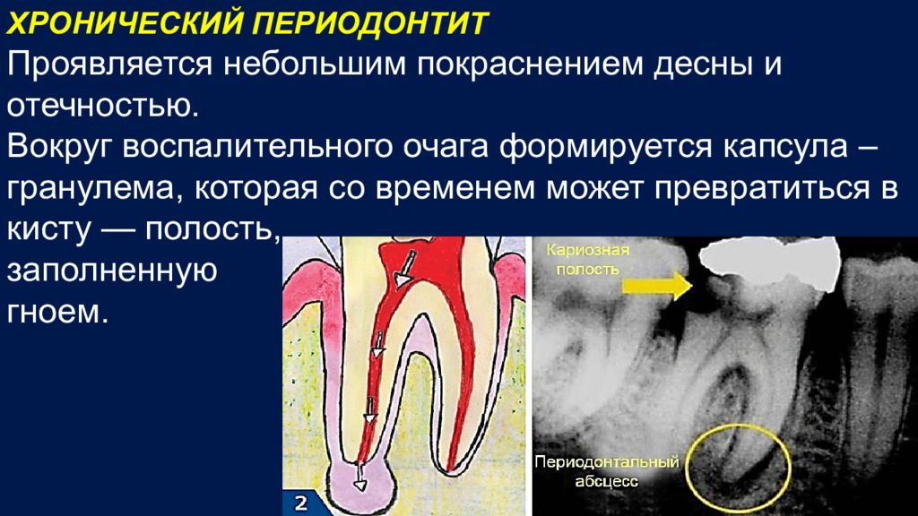Осложнение лечения периодонтита. Хронический периодонтит схема. Апикальный периодонтит зуба 2.4.