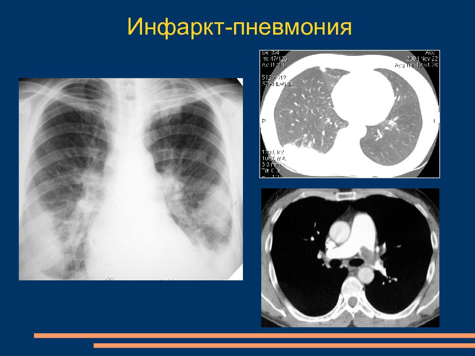 Микроплазменная пневмония. Инфаркт пневмония при Тэла на кт. Инфарктная пневмония легких кт. Тэла инфаркт пневмонии на кт.