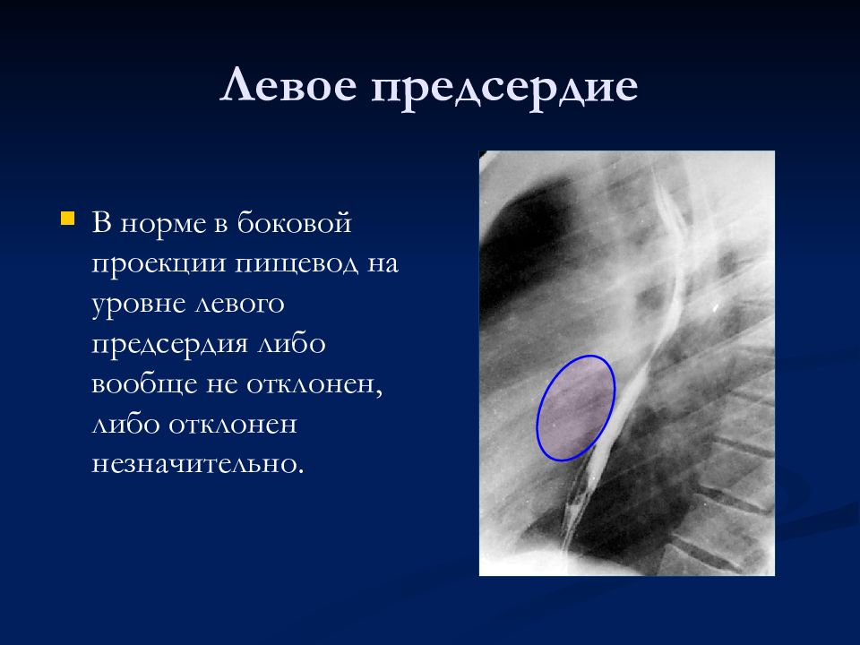 Патология левого предсердия. Пищевода в боковой проекции. Лучевая анатомия сердца в норме. Боковая проекция сердца при патологиях. Лучевая анатомия сердца.