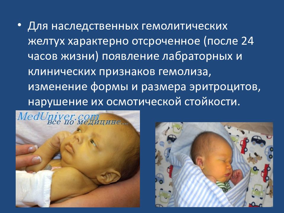 Желтуха симптомы у детей. Физиолог желтуха новорожденных. Гемолитическая и физиологическая желтуха. Гемолитическая желтуха новорожденного. Наследственные желтухи у новорожденных.