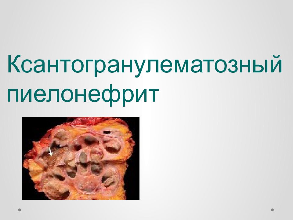 Ксантогранулематозный пиелонефрит