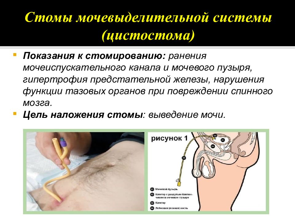 Уход за цистостомой презентация