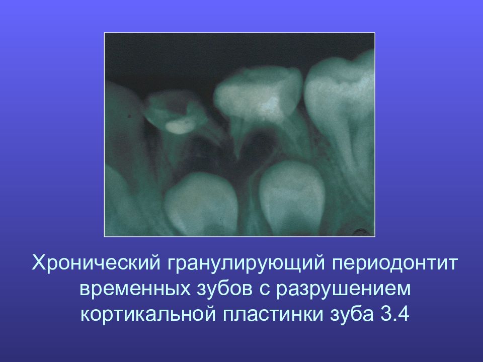 Для рентгенологической картины фолликулярной кисты характерна деструкция костной ткани