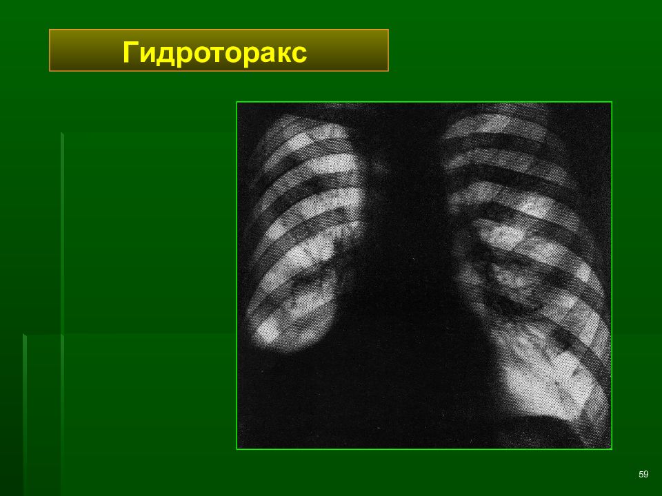 Диагноз гидроторакс. Лучевая диагностика заболеваний легких. Гидроторакс лучевая диагностика.