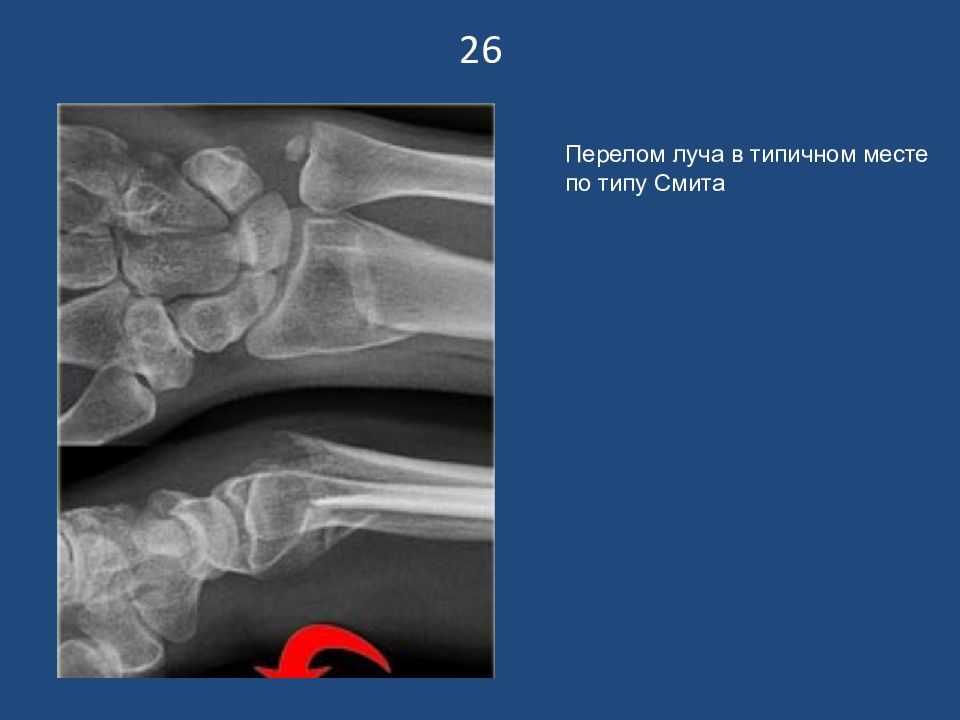 Перелом справа. Перелом Смита рентгенограмма. Перелом луча в типичном месте рентген. Перелом Коллиса рентген.