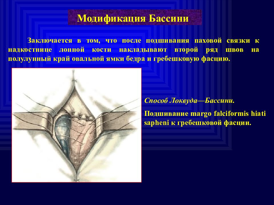 Бедренный способ при бедренной грыже. Бедренная грыжа по Бассини. Операция Бассини бедренная грыжа.