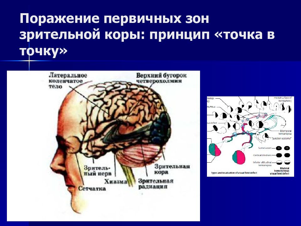 Переработка информации в зрительной коре. Поражение зрительной коры. Где находится Зрительная зона головного мозга. Зрительная зона коры.