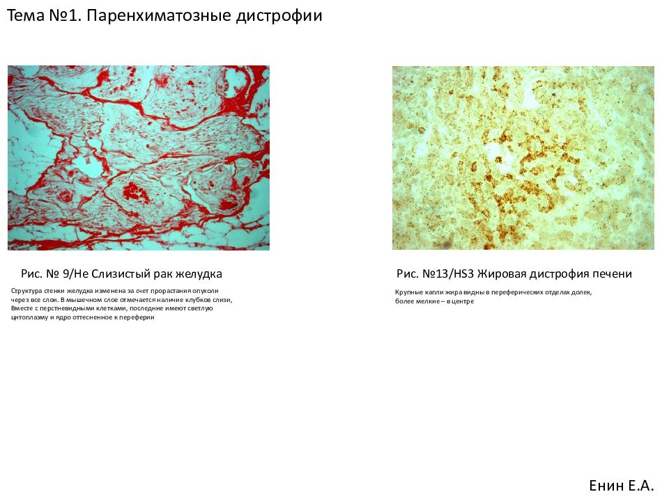 Опухоль с преобладанием паренхиматозной ткани на ощупь. Паренхиматозная слизистая дистрофия. Слизистая коллоидная дистрофия. Роговая паренхиматозная дистрофия. Паренхиматозные дистрофии. 1.