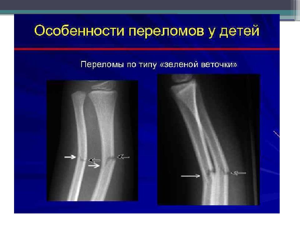 Особенности переломов костей