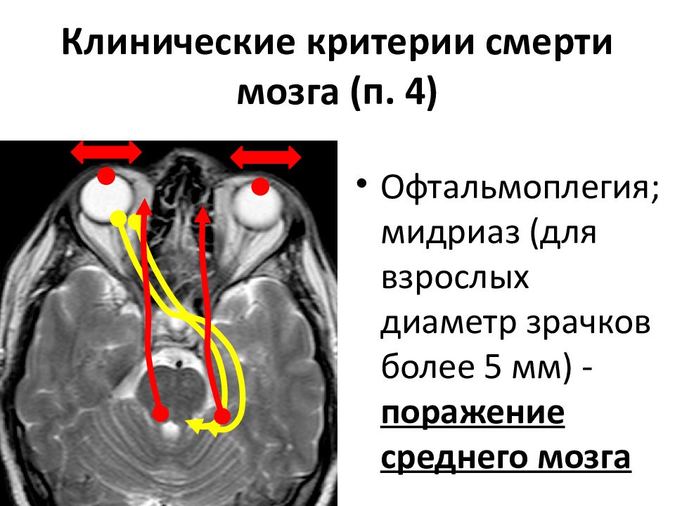 Умерли мозги. Смерть мозга критерии диагностики. Клинические критерии смерти мозга. Смерть мозга неврология. Перечислите основные критерии смерти мозга.