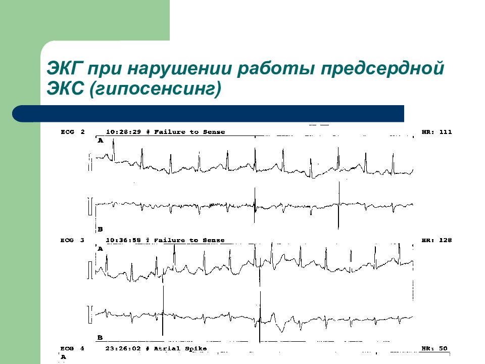 Экг при нарушениях ритма и проводимости презентация