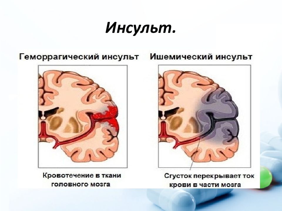 Что такое ишемический инсульт головного мозга