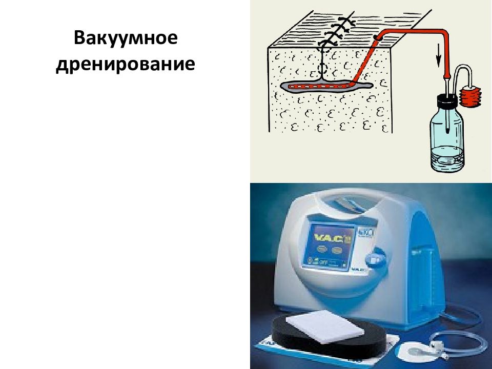 Дренаж ран. Дренирование по Редону. Вакуумное дренирование. Вакуумное дренирование РАН.