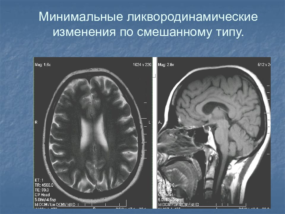 Картина наружной гидроцефалии. Мрт ликвородинамика головного мозга. Ликвородинамические нарушения гидроцефалия. Нарушение ликвородинамики головного мозга на мрт. Внутренняя гидроцефалия.