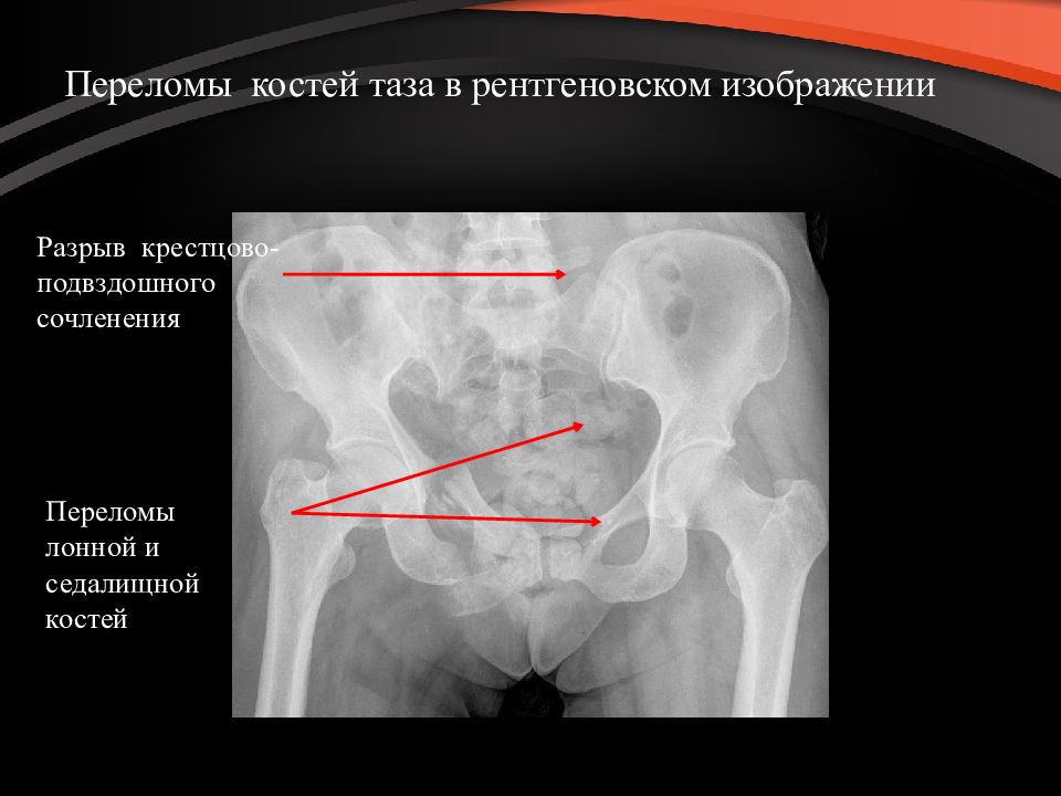 Презентация на тему перелом костей таза